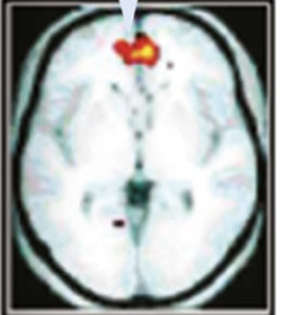 <p>More likely to recall information if you can relate to yourself! </p><ul><li><p>mPFC more active!</p></li></ul><p></p>
