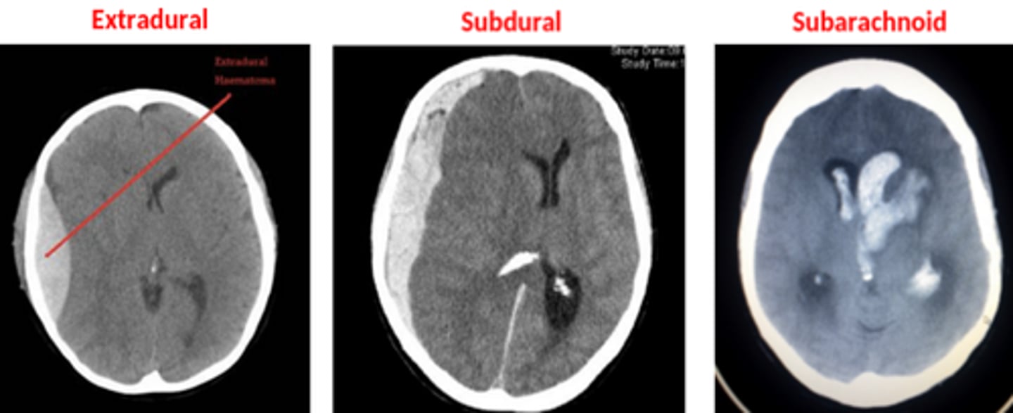 <p>- various trauma or stroke causes damage to cerebral arteries, which bleed into subarachnoid space</p><p>- most likely caused by rotational acceleration and breakage of vessels</p><p>- vasospasm can occur in attempt to reduce blood flow to bleeding vessels, may cause focal areas of ischaemia</p><p>- blood mixes with CSF, so can be diagnosed with blood in spinal tap</p>