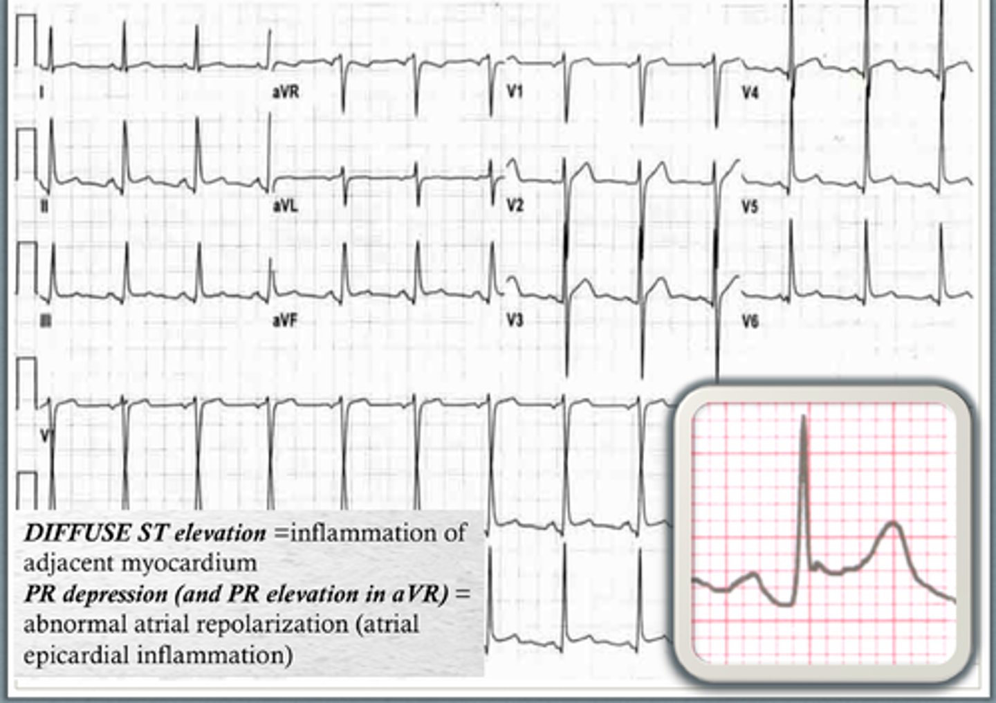 <p>- widespread concave ST elevation</p><p>- ST/T ratio &gt;0.25</p><p>- widespread PR depression</p><p>- sinus tachycardia</p>