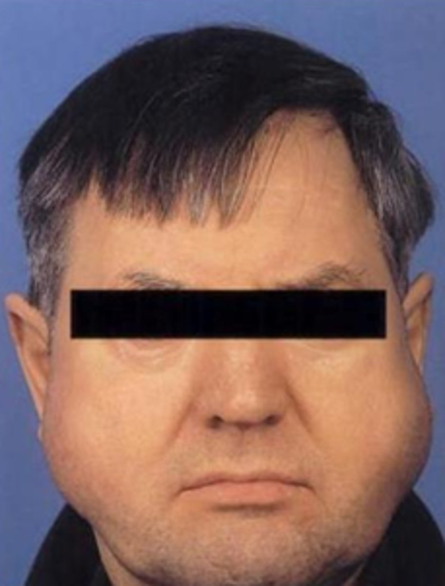 <p>Sialiadenosis</p>