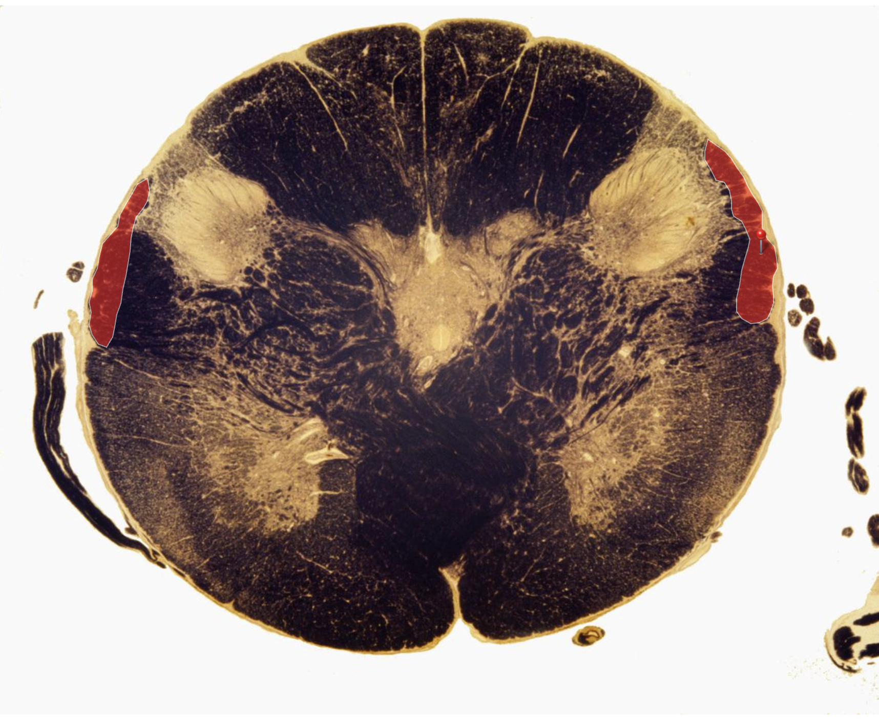 <p>Dorsal Spinocerebellar Tract (ipsilateral, enters via inferior peduncle)</p><p></p><p>Transmits <strong>lower limb proprioception </strong><em><u>For Individual Muscles</u></em></p>