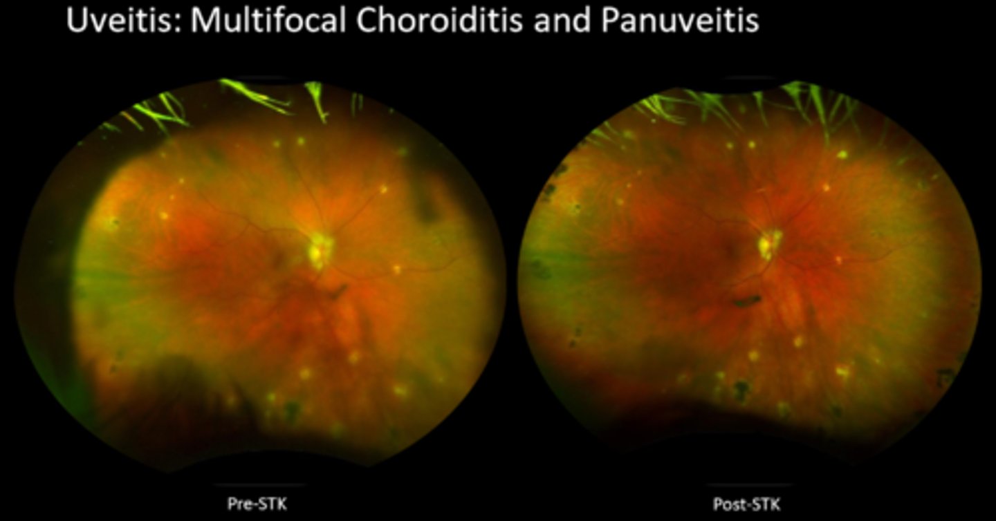 <p>What are some indications for intraocular steroids?</p>