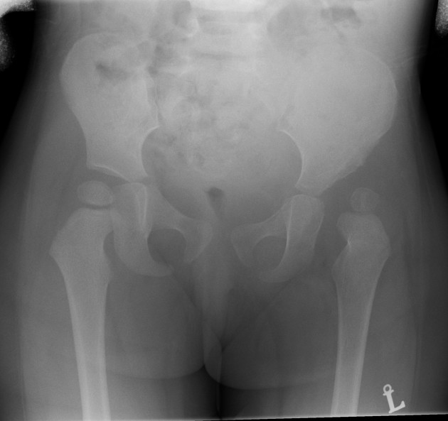 <p>Define this pathology and describe the RA and symptoms</p>