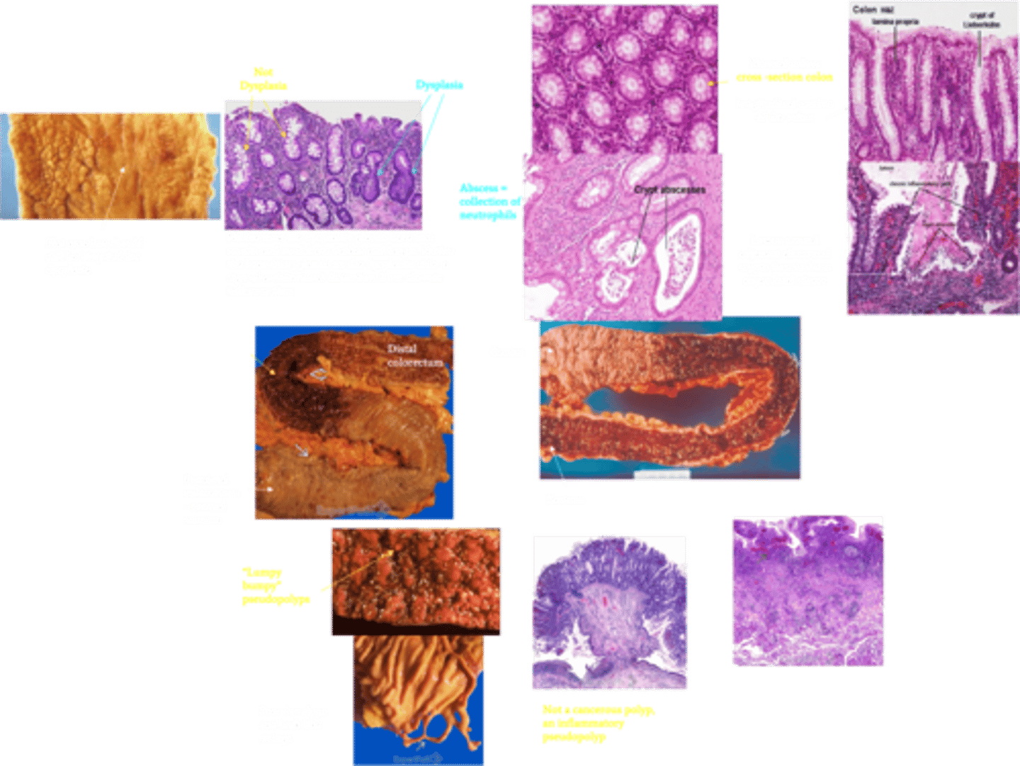 <p>Define Condition:</p><p>Inflammation limited to colon and rectum, and extends only into the mucosa and submucosa</p><p>-Hx:</p><p>&gt; Smoking is protective</p><p>&gt; A/w PSC</p><p>-Path:</p><p>&gt; Immune Defect = Defect in Th2 T-Cells --&gt; Elaborates IL-13 (key cytokine in initiating pro-inflammatory cascade)</p><p>&gt; Categories (based on location): Rectum is almost always involved (95%)</p><p>&gt;&gt; Only Rectum = Proctitis</p><p>&gt;&gt; Rectum + Sigmoid = Proctosigmoiditis</p><p>&gt;&gt; Left side of LI = Left-sided</p><p>&gt;&gt; Entire Colon = Pancolitis</p><p>&gt; Mucosa &amp; Submucosa only</p><p>-Sx/PE: Episodic</p><p>&gt; Bloody Diarrhea</p><p>&gt; Lower Abdominal Cramping</p><p>&gt; Fatty Stools</p><p>&gt; Wt Loss</p><p>-Dx:</p><p>&gt; Serum: (+) p-ANCA/MPO-ANCA</p><p>&gt; Endoscopy: Backwash Ileitis</p><p>&gt;&gt; May involve terminal ileum d/t incompetent ileocecal valve --&gt; reflux of inflammatory mediators from colon --&gt; Superficial mucosal inflammation</p><p>&gt; Imaging: "Lead-pipe appearance" d/t loss of haustra in diseased section of colon (smooth walled and cylindrical like)</p><p>&gt; Gross:</p><p>&gt;&gt; Bloody &amp; diffusely Ulcerated (no skip lesions) - extends proximally</p><p>&gt;&gt; Isolated islands of regenerating mucosa bulging into lumen (Lumpy, bumpy inflammatory pseudopolyps)</p><p>&gt; Biopsy:</p><p>&gt;&gt; Superficial mucosal disease</p><p>&gt;&gt; Mild (erosions) to severe (ulcers penetrating mucosa to submucosa) +/- cryptitis and Crypt Abscesses</p><p>-Prog:</p><p>&gt; IDA d/t blood loss</p><p>&gt;&gt; Bloody diarrhea w/ mucus</p><p>&gt;&gt; Rectal bleeding</p><p>&gt; Risk of Colon ACA (more in pts w/ Pancolitis 10+ yrs)</p><p>&gt;&gt; Dysplasia of colonic mucosa (FLAT mucosa) = High risk</p><p>&gt;&gt; Usually infiltrative w/o obvious exophytic masses</p><p>&gt; Toxic Megacolon</p><p>&gt;&gt; Cessation of colonic contractions d/t NO made by neutrophils &amp; macrophages ==&gt; inhibits smooth-muscle tone and disturb NM function ==&gt; Intestinal dilation ==&gt; Distension ==&gt; PERFORATION</p><p>&gt; PSC --&gt; HIGH RISK of Colon Cancer</p>