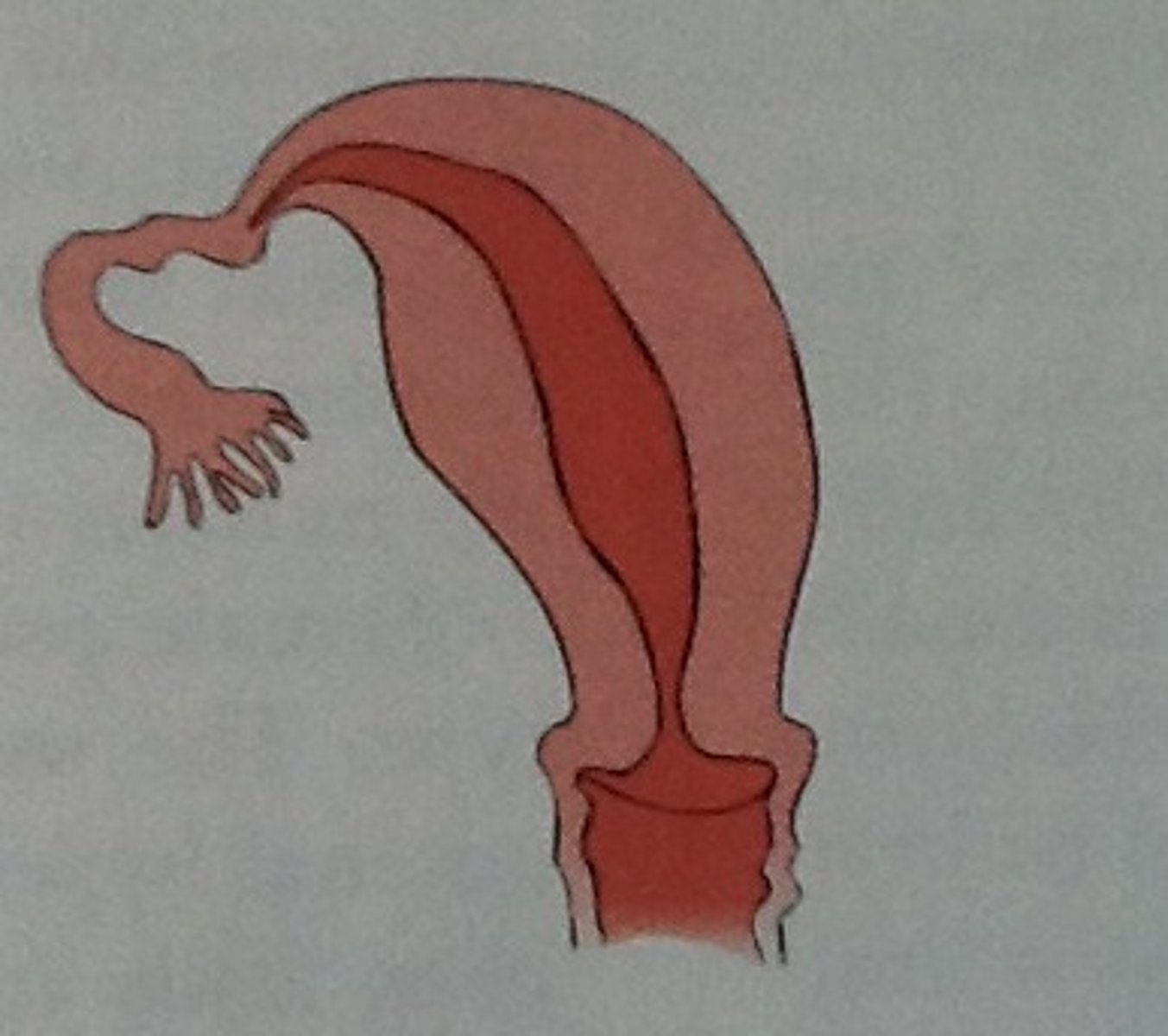 <p>One-sided uterus.</p>