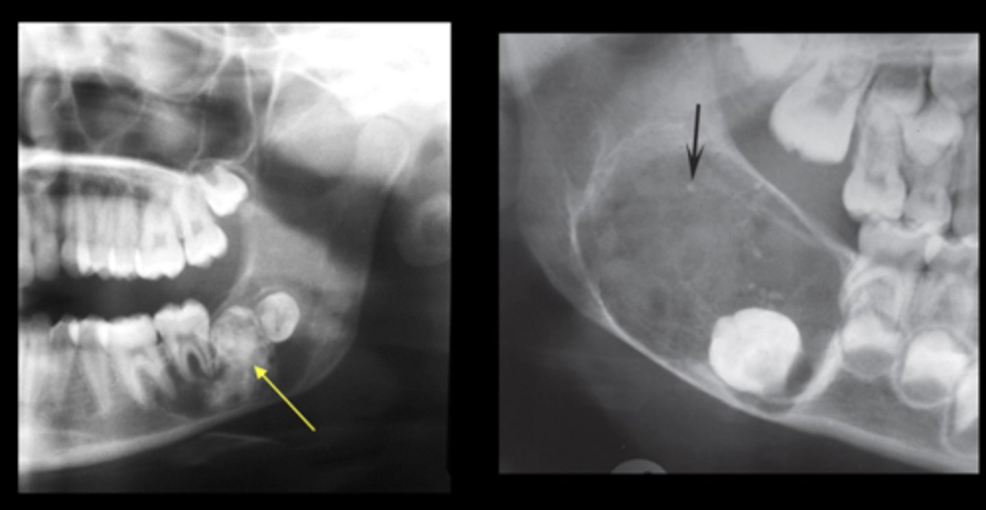 <p>• well-defined radiolucency + radiopaque component</p><p>*small fleck to large calcified masses</p>