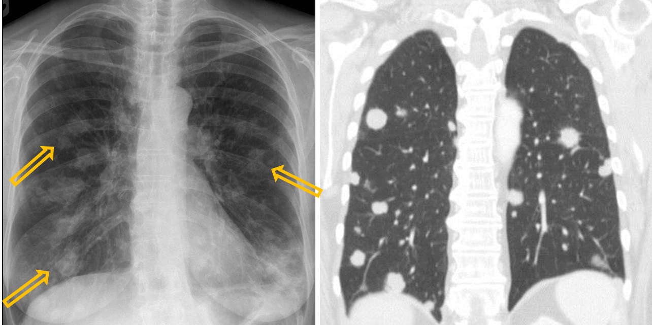 <p>Patient history: melanoma malignum, staging </p><p>Modality: left image – PA chest radiograph (upright); right image – postcontrast chest CT; lung window setting, iv. iodine-based contrast agent </p><p>Region: chest, lung </p><p>Radiologic sign: Multiple soft tissue lesions showing different size and rounded shape (yellow arrows), number of nodules is higher at the base than the apex due to its higher perfusion. </p><p>Diagnosis: multiple lung metastases</p>