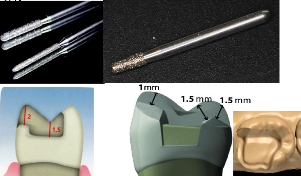 <p><strong>Conical diamond bur with rounded tip</strong></p><p class="has-focus">No contact point between cavity margin and adjacent tooth</p><p class="has-focus">Axial reduction with <strong>conical flathead</strong> and round tip bur, with <strong>deep chamfer</strong></p><p class="has-focus">No sharp angles</p><p class="has-focus">No bevels</p><p class="has-focus">90° cavosurface angle</p><p class="has-focus">At least 0.5mm gingival enamel (good marginal seal)</p><p class="has-focus">No occlusal contact on restoration - tooth interface</p><p class="has-focus">1.5 - 2mm thickness for cusp coating</p>