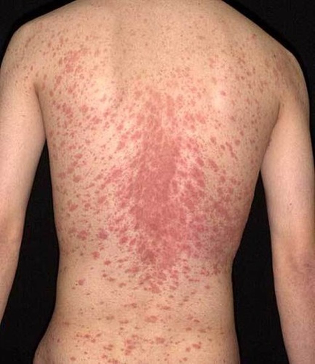 <p>viral infection</p><p>-"herald patch" which is salmon colored oval on trunk/arms</p><p>-2 weeks later = generalized eruption of papules w/ centripetal scaling</p><p>"Christmas tree pattern"</p>