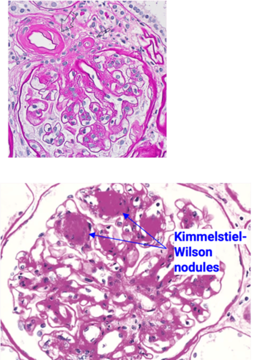 <p>Define Condition:</p><p>MCC of ESRD in U.S.</p><p>-Path: AGEs crosslink w/ Collagen IV in Basement Membrane --&gt; DIFFUSE THICKENING, esp of VASCULAR VM ==&gt; HYALINE ARTERIOSCLEROSIS (more of EFFERENT Arteriole) --&gt; More pressure in Glomerulus --&gt; Increased GFR --&gt; Hyperfiltration of Glucose (Pulls water) ==&gt; Polyuria --&gt; Eventually, renal failure &amp; Decrease in GFR</p><p>-Sx/PE: Polyuria</p><p>-Dx:</p><p>Histo = Thickened GBM --&gt; loss of size &amp; charge of barrier</p>