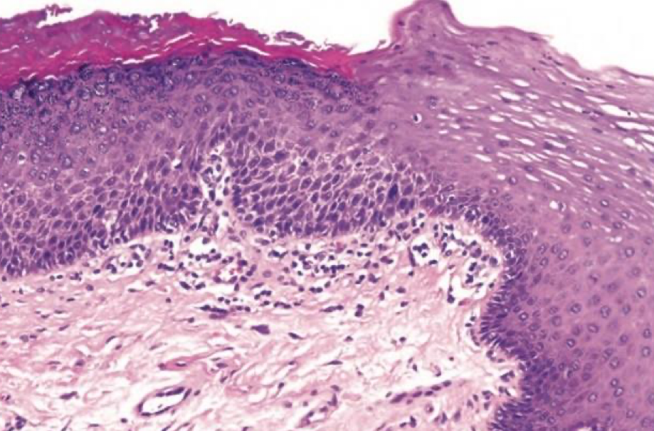 <p>which neoplastic white lesion:</p>