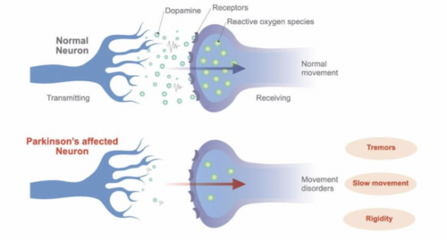<p>A movement disorder with symptoms of tremors, muscle rigidity, and the inability to initiate movement.</p>