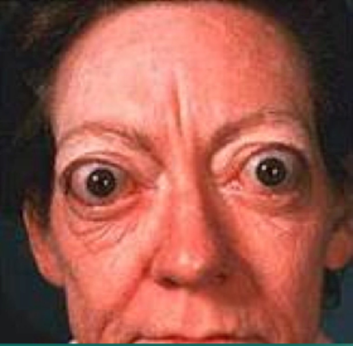 <p>1. Weight loss<br>2. Increased appetite<br>3. Irritable<br>4. Tremor<br>5. Palpitations<br>6. Goitre<br>7. Diarrhoea<br>8. Heat intolerance<br>9. Malaise (general feeling of discomfort)<br>10. Vomiting</p>