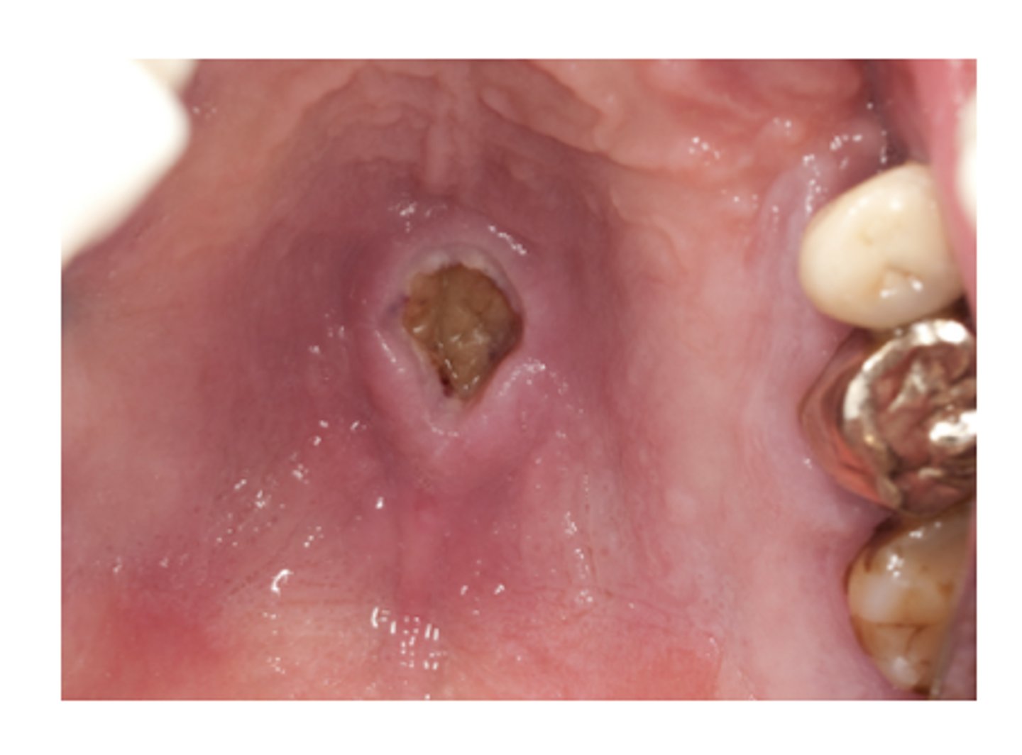 <p>Ischemia of the salivary glands of the hard palate, Often bilateral and symmetrical, starts out initially as a swelling </p>