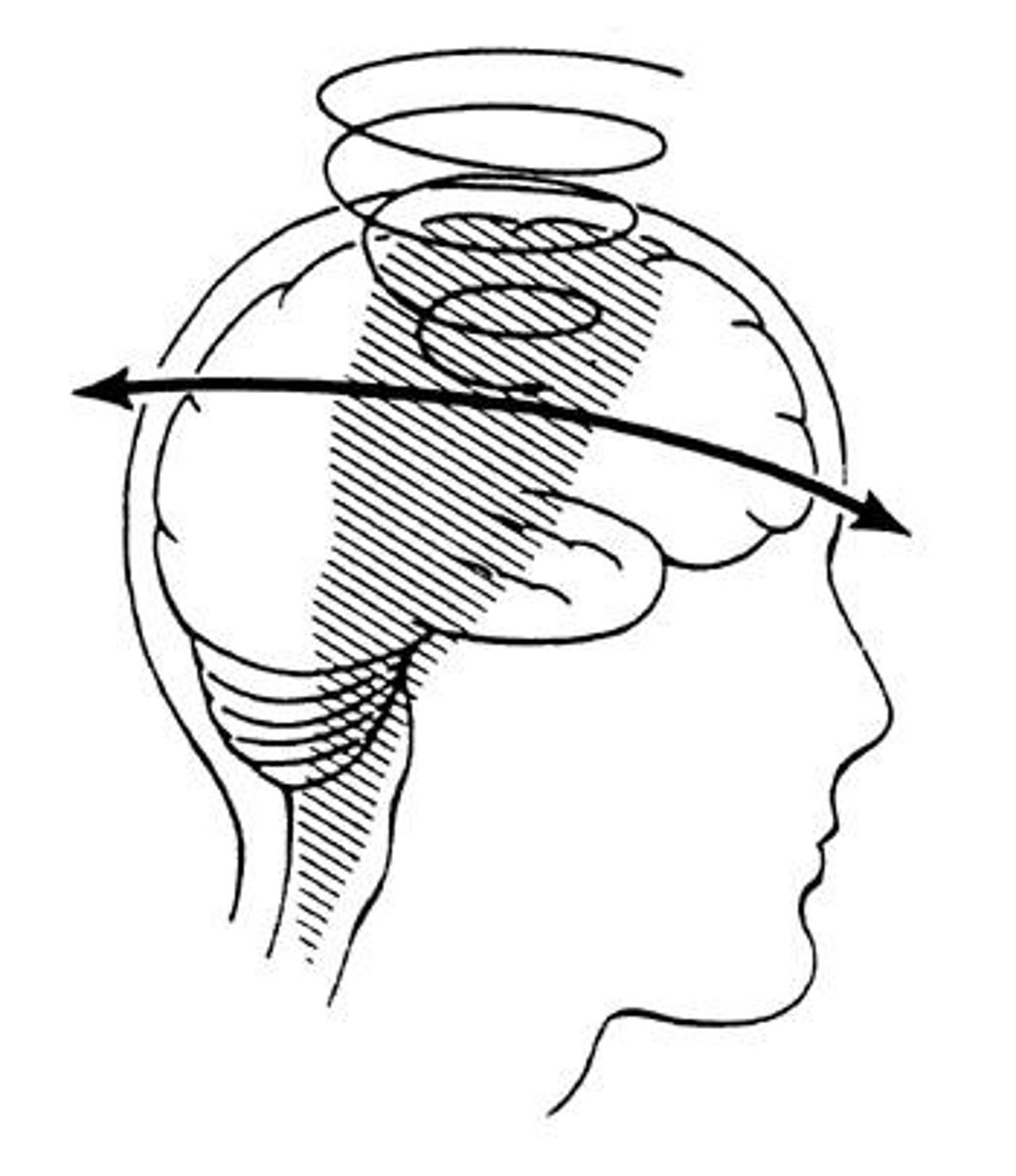 <p>Brain movement within the skull from impact.</p>