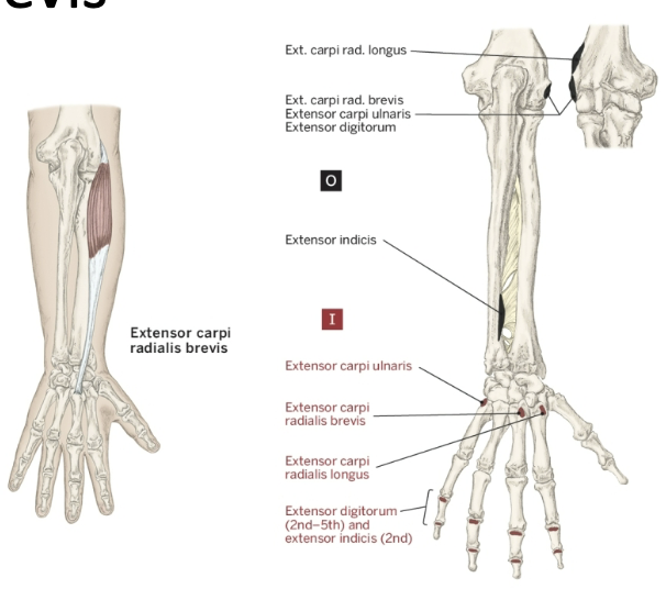 <p>Action of the Extensor Carpi Radialis Brevis</p>