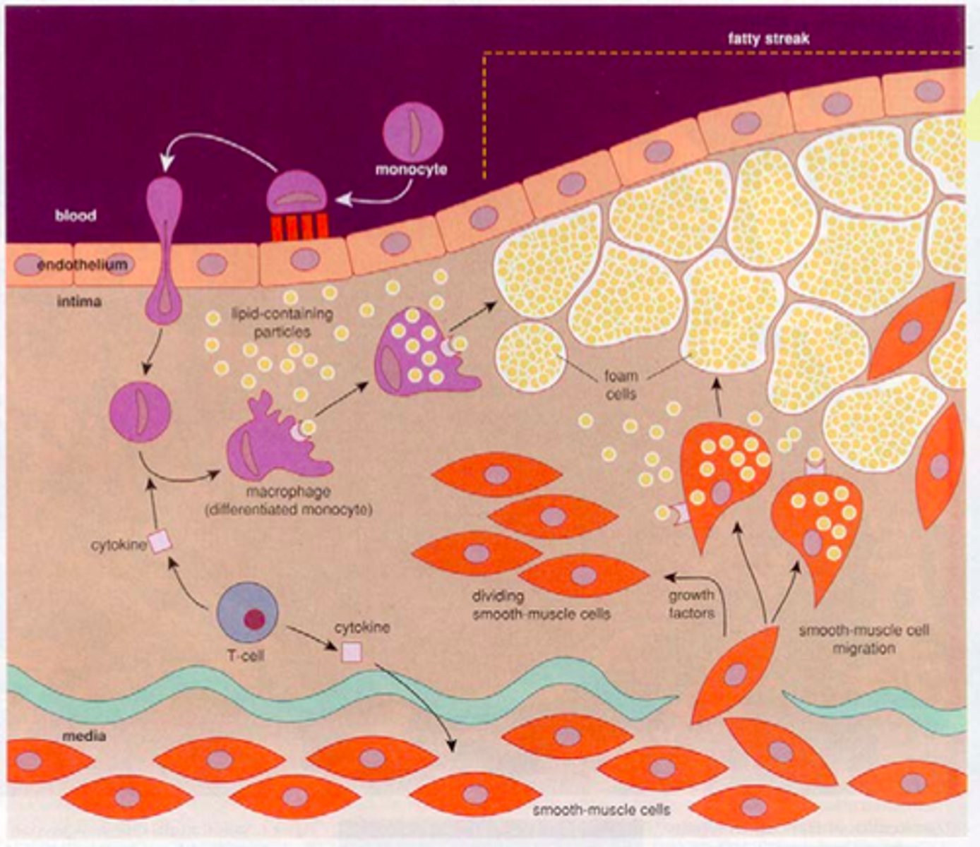 <p>1. initiation - fatty streak triggered by endothelial dysfunction. lipids (LDL) enters endothelium and forms a layer within the tunica intima. these lipoproteins are oxidised. this triggers proteins receptor expression on endothelium for leucocyte recruitment. </p><p>2. Foam cells are formed by monocytes/macrophages that have phagocytise oxidised LDLs. </p><p>2. Fibrous cap atheroma. Dead foam cells accumulate and release lipids. Lymphocytes, ECM, smooth muscle cells, collagen, elastin (all from tunica media) are encapsulated by the fibrous cap between vessel lumen and core of plaque. thin capsule is prone to rupture. </p><p>4. if the plaque ruptures, erythrocytes can accumulate and form a thrombus. </p>