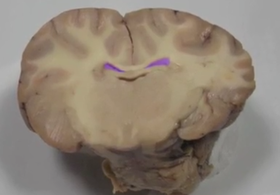 <p>Lateral ventricles </p>