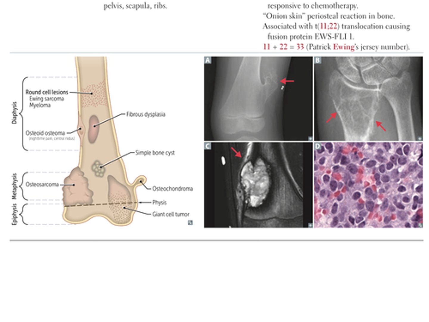<p>tumor type: benign primary bone tumor</p><p>epidemiology/location:</p><p>- most common benign bone tumor</p><p>- males < 25 years old</p><p>characteristics:</p><p>- bony exostosis with cartilaginous (chondroid) cap (A)</p><p>- rarely transforms to chondrosarcoma</p>