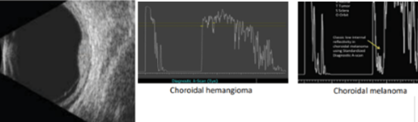 <p>Compared to an amelanotic choroidal melanoma, a choroidal hemangioma will appear ____ on B scan and will have _____ on A scan</p>