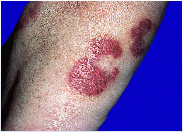 <p>32M 3-month hx painless rash over arms, weight loss</p>