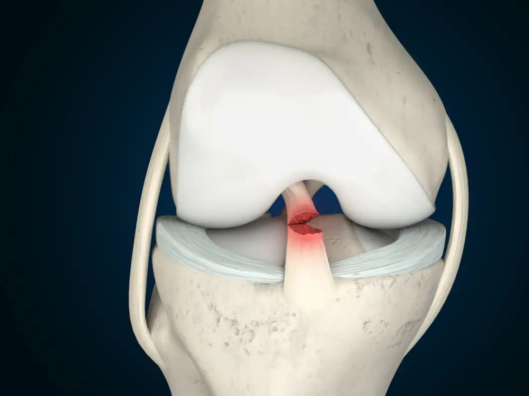 <p>right under the patella in front of the posterior cruciate ligament</p>