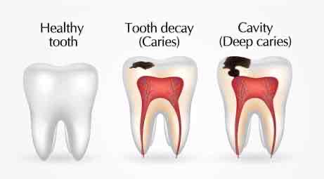 <p>Cavities in the teeth (caries means “decay”)</p>