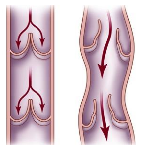 <ul><li><p>With age, the walls of the veins become distended (swollen) on the heart side of each valve.</p></li><li><p>This cause blood to pool instead of flow efficiently back to the heart.</p></li><li><p>Often seen in veins of the arms or legs, where blood flow opposes gravity</p></li></ul><p></p>