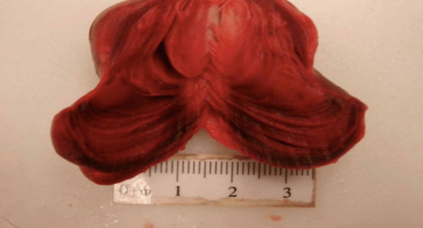 <p>What type of thrombus is being shown</p>