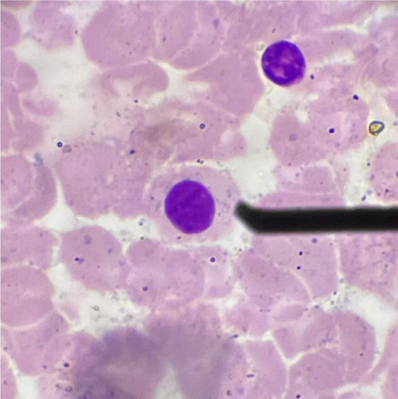 <p>A. Identify the cell (Normoblastic / Rubriblastic / Erythroblastic)</p><p>B. Striking feature</p><p>C. The pink coloration of the cytoplasm is due to what staining property?</p><p></p>