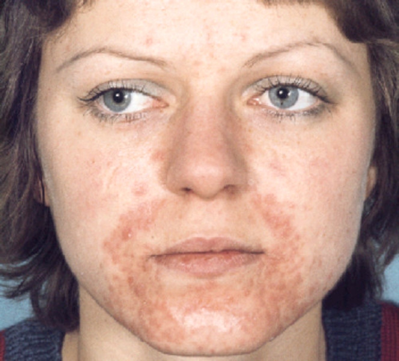 <p>diagnose this image:</p><p>Small erythematous papules and pustules w/ erythema and +/- scaling around the mouth</p>