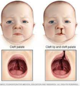 <p><span>can occur with or without cleft lip</span></p>