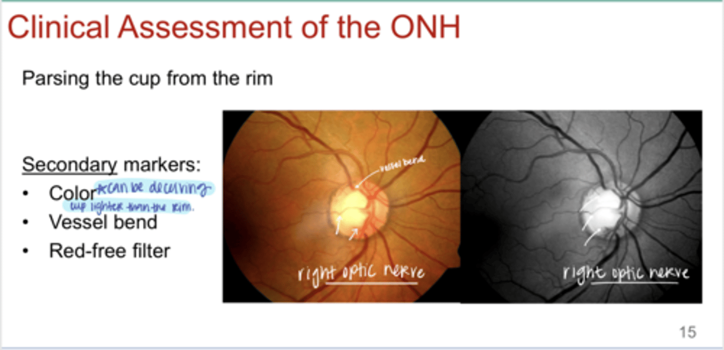 <p>What are secondary markers that can help distinguish cup from rim?</p>