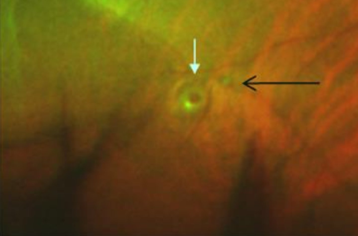 <p>intrabasal = within vit base = held down better</p><p>juxtabasal = next to vit base = greater risk of RD</p>