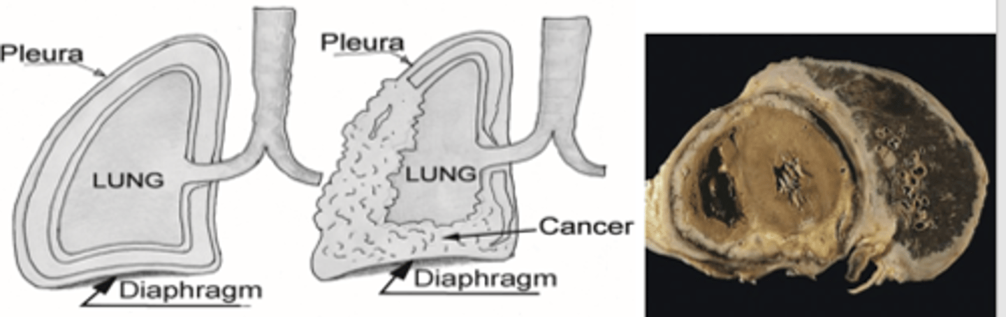 <p>Mesothelioma</p>