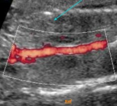 <ol><li><p>What pathology is seen here?</p></li><li><p>What syndrome can be seen with this pathology?</p></li></ol><p></p>