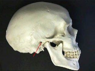 <p>Which temporal bone marking is this? (2)</p>