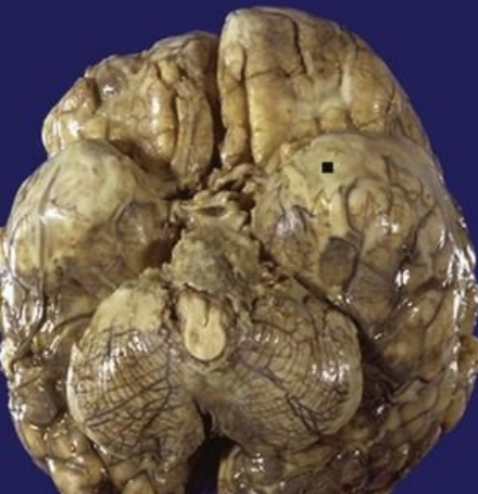 <p>8.7 Side B (PBD9: 364; BP9: 825)<br></p>
<p><br></p>
<p>Questions<br></p>
<p>A 3-month-old infant with fever and papilledema dies despite antibiotics. Autopsy of brain shown.<br></p>
<p><br></p>
<p>1. What is present?<br></p>
<p>2. What organisms are likely?<br></p>
<p>3. Explain the papilledema.<br></p>
<p>4. How could death occur?<br></p>