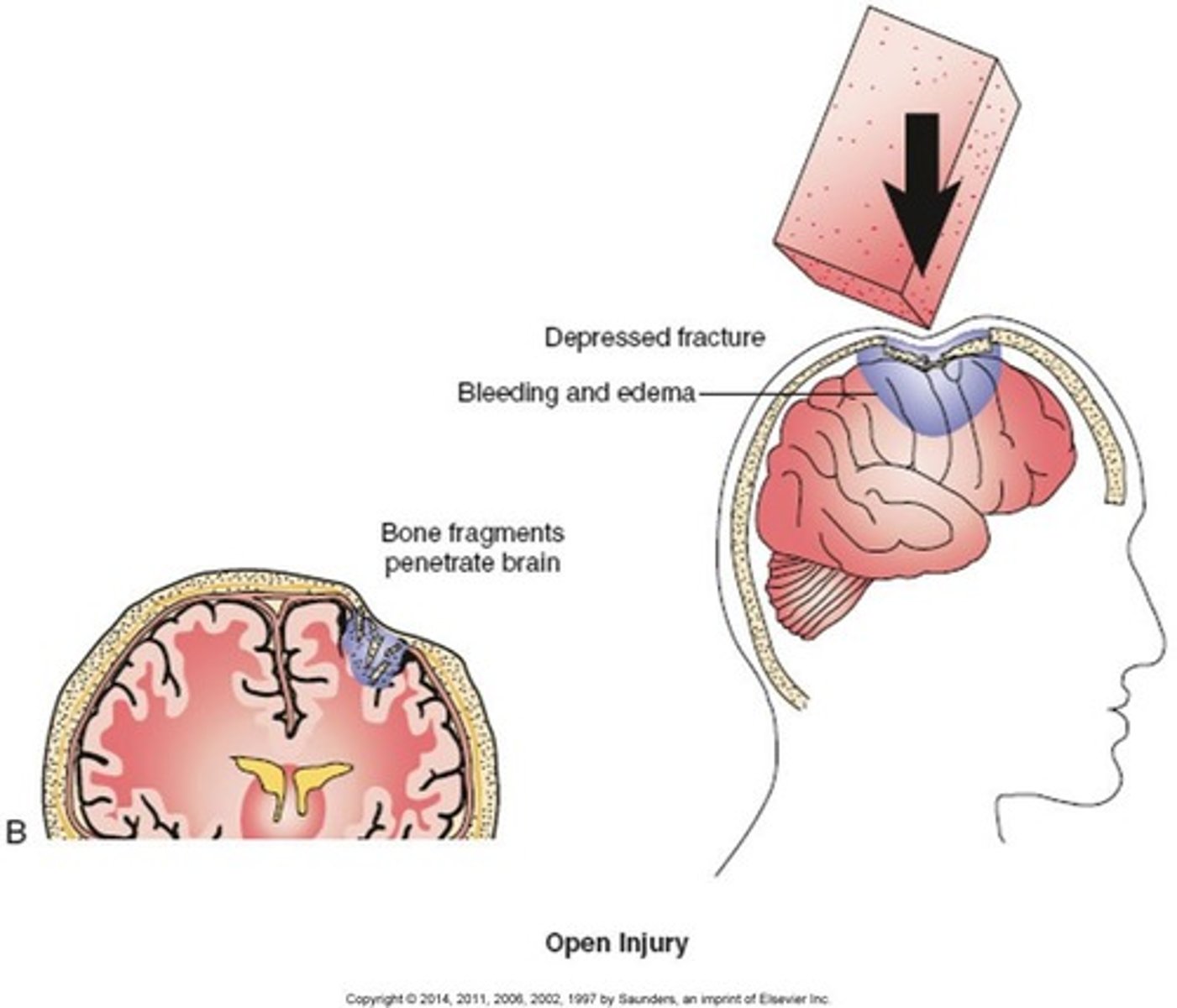 <p>-skull is fractured and meninges torn, brain is exposed to the environment</p><p>-Skull is pierced by an object, and meninges are ruptured</p><p>-Could be caused by a bullet, shrapnel, bone fragment, or weapon such as a bat, hammer, or knife</p><p>-Classified as high velocity or low velocity</p>