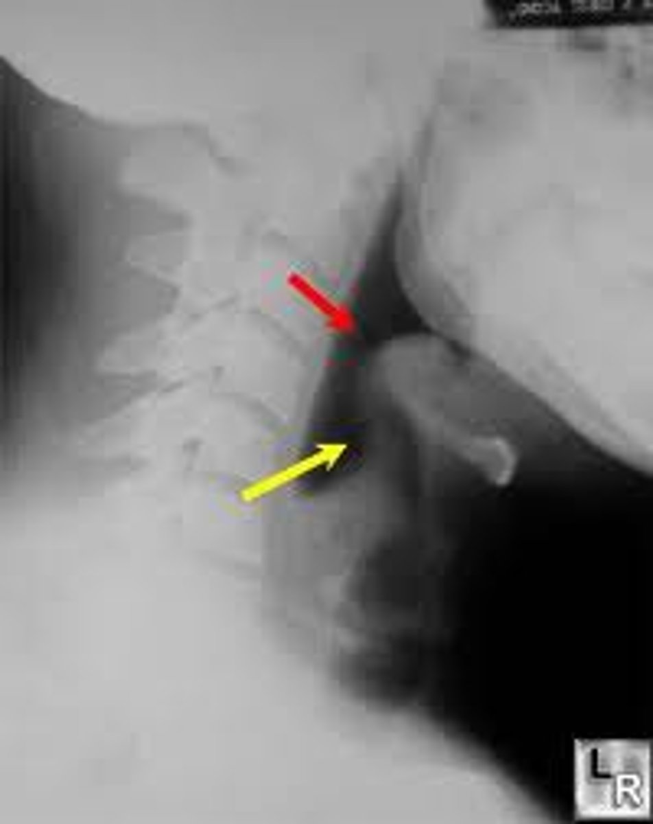 <p>ICU admit, examination using nasal fiberoptic endoscope, thumb sign on xray, emergency airway/trach tray on standby</p>