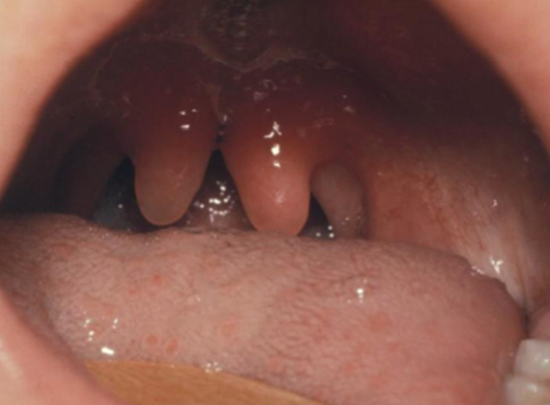 <p>minimal manifestation of cleft palate</p>