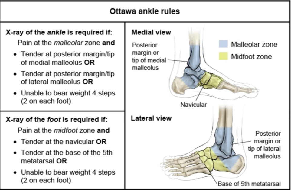<p>A: Malleolar pain + bone tenderness at posterior edge or tip of lateral malleolus or the medial malleolus or unable to walk 4 steps.</p><p><br> B: Midfoot pain + bone tenderness at the base of the fifth metatarsal or navicular bone or unable to walk 4 steps.</p>