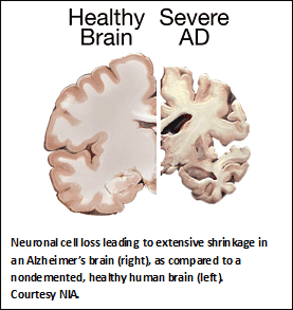 <p>A progressive type of dimentia causing the brain to shrink which destroys memory and other important mental functions.</p>