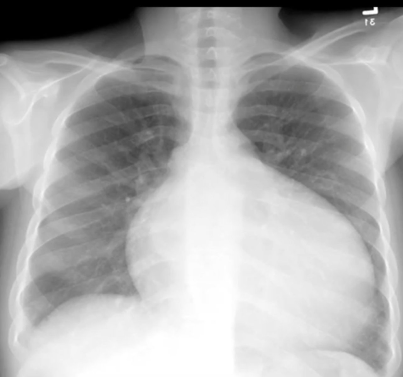 <p>(evaluating AP CXR) cardiomegaly where the entire heart is enlarged bc of fluid around the heart (effusion) or dilated cardiomyopathy</p>
