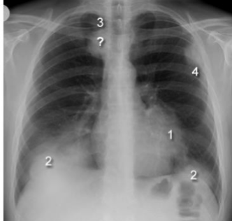 <p>What are these silhouette signs? what causes them?</p>