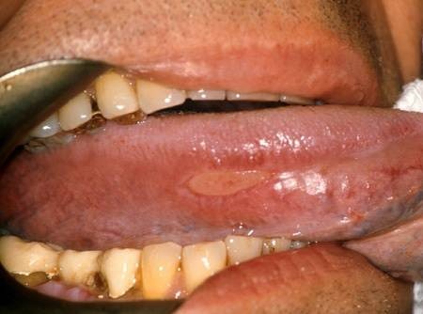 <p>Caused by trauma-biting, vigorous brushing, eating hard pointed chips.</p><p>Usually painful</p><p>7-14 day healing time unless trauma reoccurs.</p>