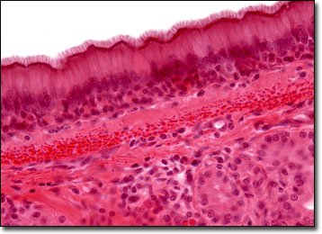 pseudo - stratified 
