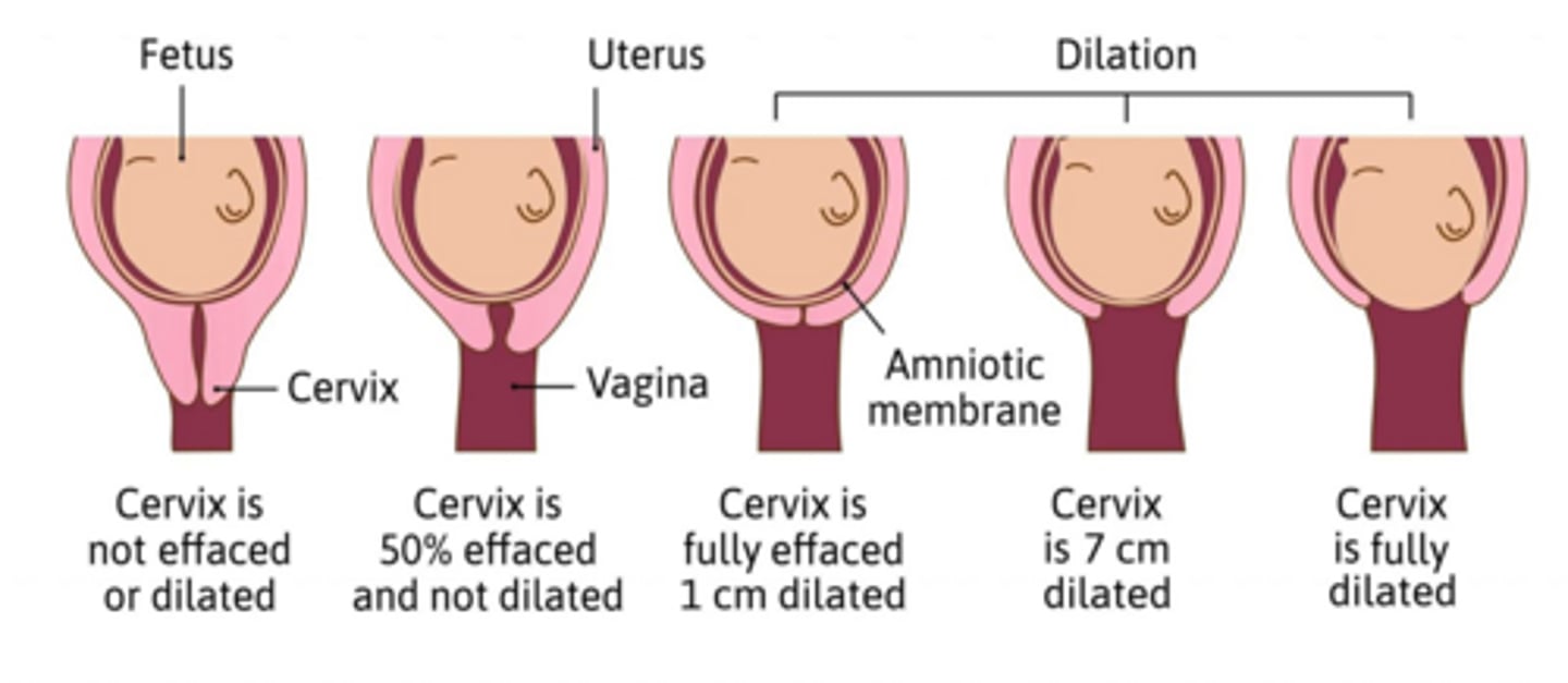 <p>Uterine contractions of 4 per 20 minutes or 8 per 60 minutes, with cervical effacement of 80% or cervical dilation of 2 cm or more.</p>