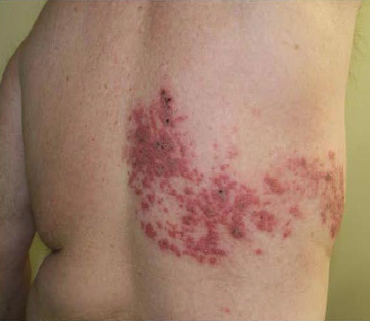 <ol><li><p>raised, blistered rash - follows dermatomes, area along a nerve and does not cross midline of your body; tale-tell sign. </p></li><li><p>upset GI </p></li><li><p>fever, chills</p></li><li><p>headache </p></li><li><p>itching or tingling </p></li><li><p>reddish or discolored skin</p></li><li><p>generally feeling unwell</p></li><li><p>burning or shooting nerve pain </p></li></ol><p></p>