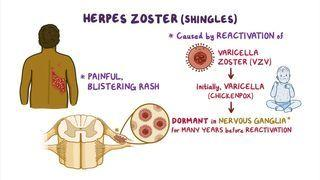 <p>PP: reactivation of varicella-zoster virus</p><p>E: varicella-zoster virus (VZV)/chicken pox</p><p>CM: <strong>pain→red papules+plaques→blisters<br>UL on a dermatome</strong><br>leukocyte adhesion deficiency (LAD)<br>elderly→scar<br>immunocompromised→scar</p><p>TX:<br>NP:<br>immunocompromised→inpatient tx<br>varicella-zoster vaccine (recommended for 60+ y/o)</p><p>MX:<br>acyclovir</p><p><u>post-herpetic neuralgia:</u><br>PO gabapentin<br>topical capsaicin</p><p>P: eye→temporary/permanent blindness (hutchinson’s sign)<br>ear→hearing loss (ramsay-hunt syndrome)<br>20+ lesions outside dermatome→disseminated</p>